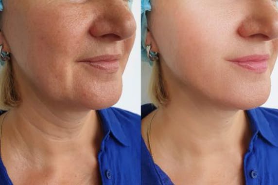 Glass Skin Collagen Mask photo review